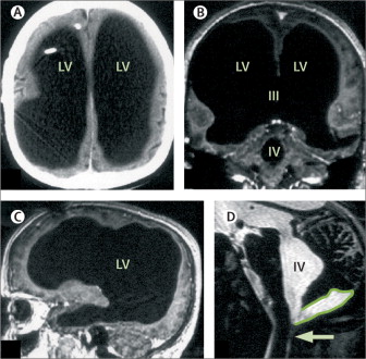 Massive ventricular enlargement, in a patient with normal social functioning